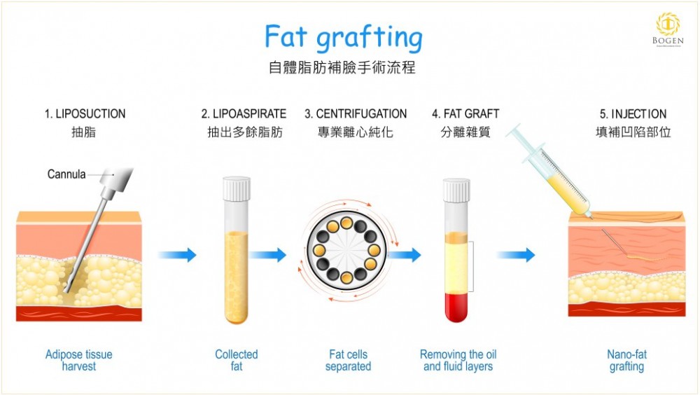 自體脂肪補臉手術流程,博恩妍